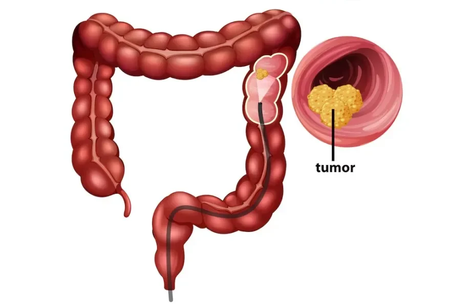 colon cancer treatment in indore, pet rog visheshagya indore, gastrologist indore