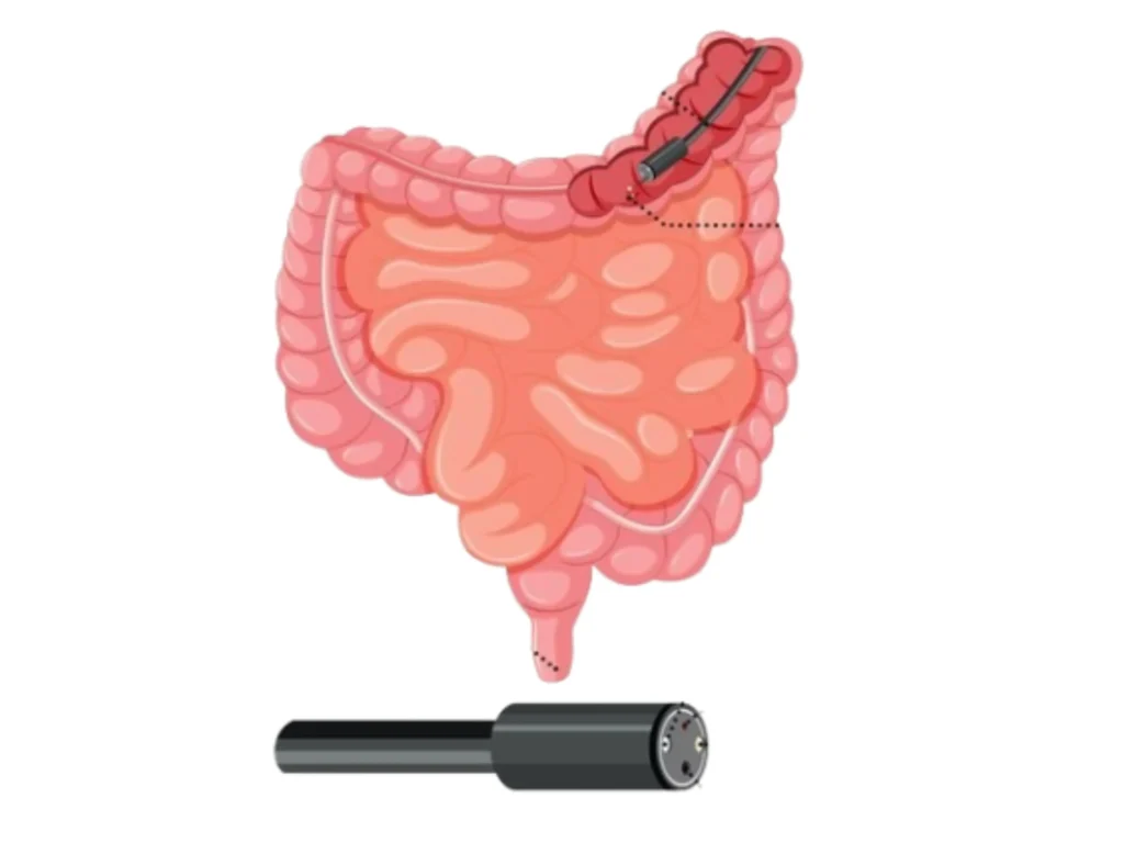 colonoscopy in indore, gastrologist in indore