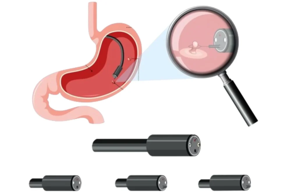 endoscopic polypectomy, gastro doctor in indore