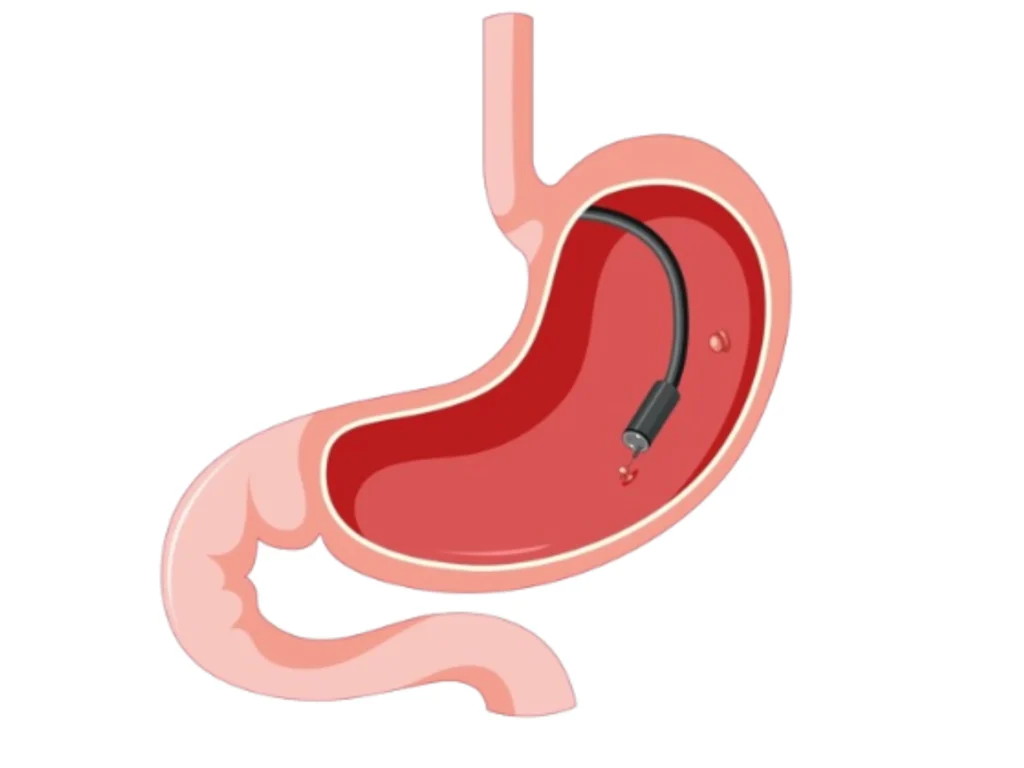 gastroscopy in indore, gastro doctor in indore