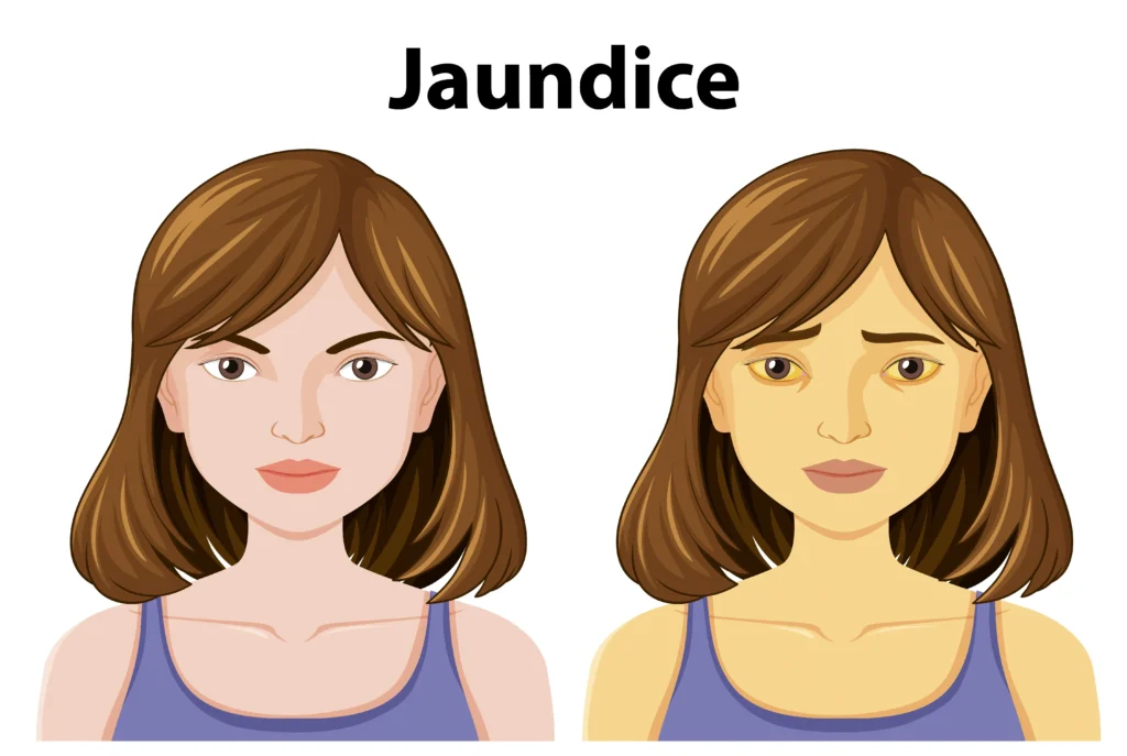 jaundice treatment in indore, best gastroenterologist indore