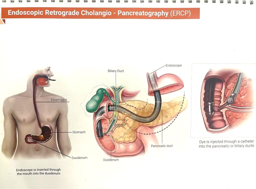 endoscopic retrograde cholangiopancreatography, gastrologist indore