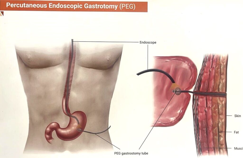 Percutaneous Endoscopic